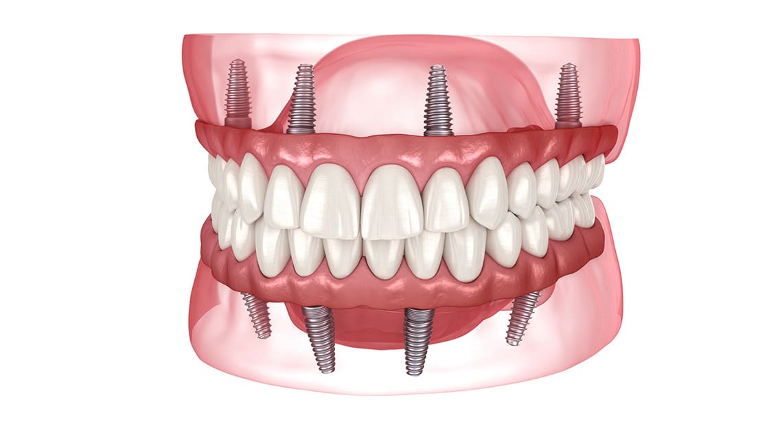 The Types of Implant Treatment We Provide